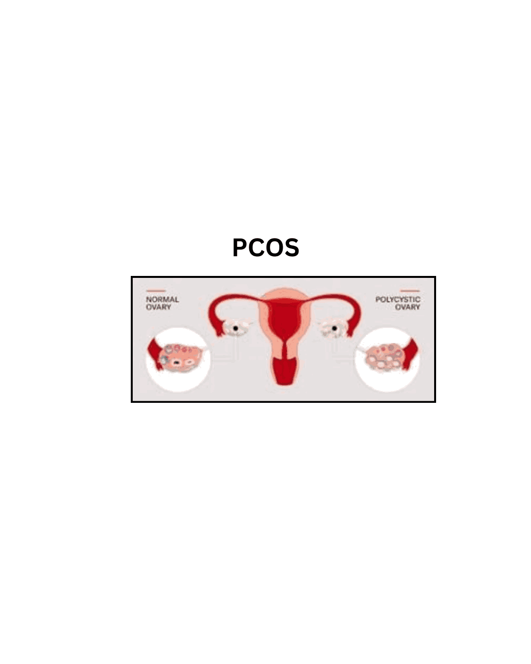 Ovarian cyst