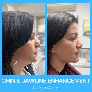 enhancing jawline